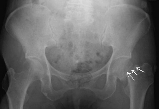 大腿骨の頸部骨折