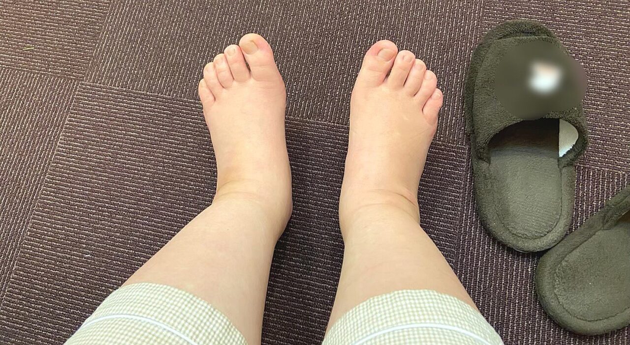 むくんだ女性の脚